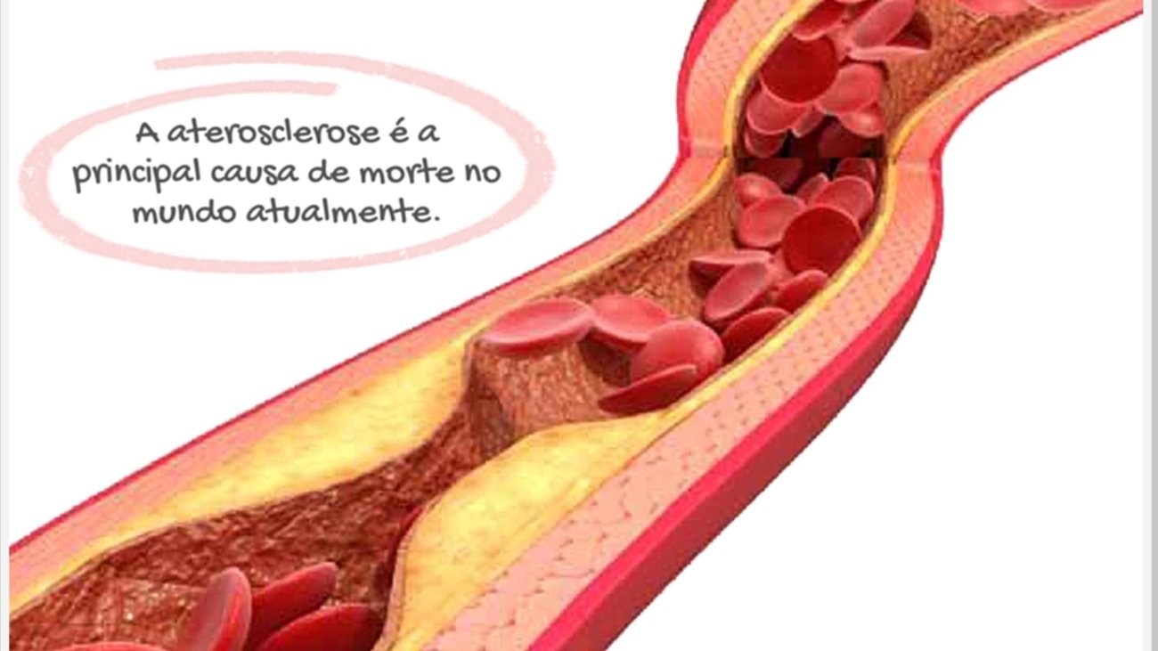 aterosclerose-cirurgiao-vascular-dr-daniel-benitti
