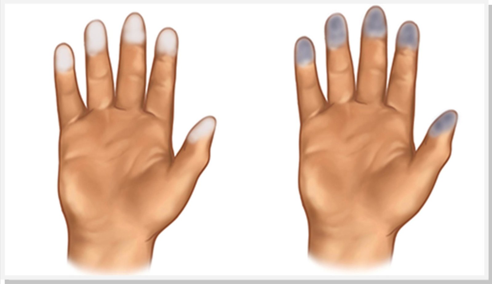 Você conhece o Fenômeno de Raynaud? Cirurgião Vascular