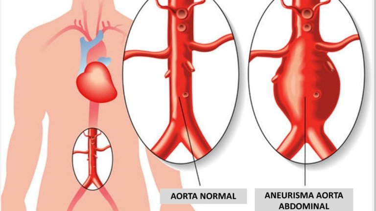 Aneurisma da Aorta - Cirurgião Vascular