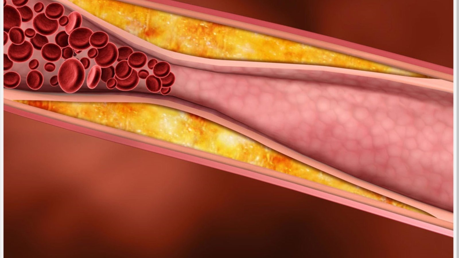 Dislipidemia-dr-daniel-benitti-cirurgiao-vascular-campinas