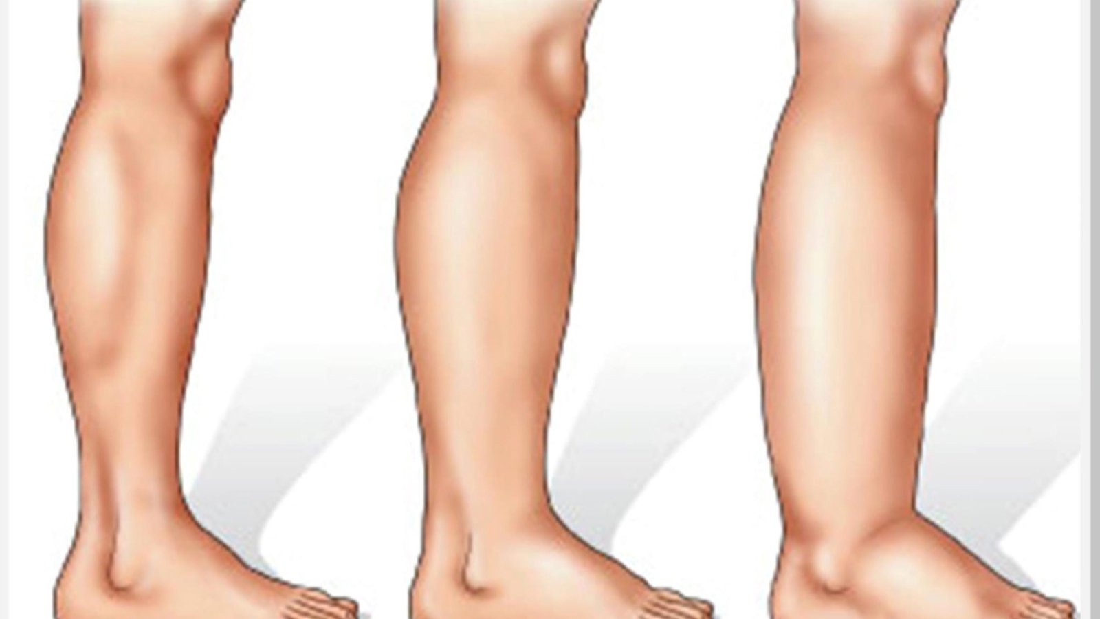 linfedema-dr-daniel-benitti-cirurgiao-vascular-campinas