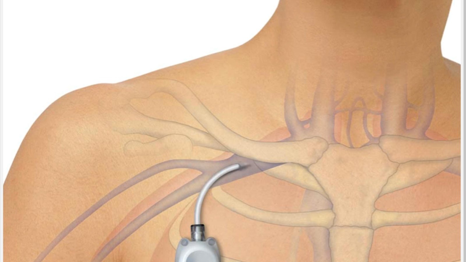 Um Port pode tornar o tratamento de câncer mais fácil? Cirurgião Vascular