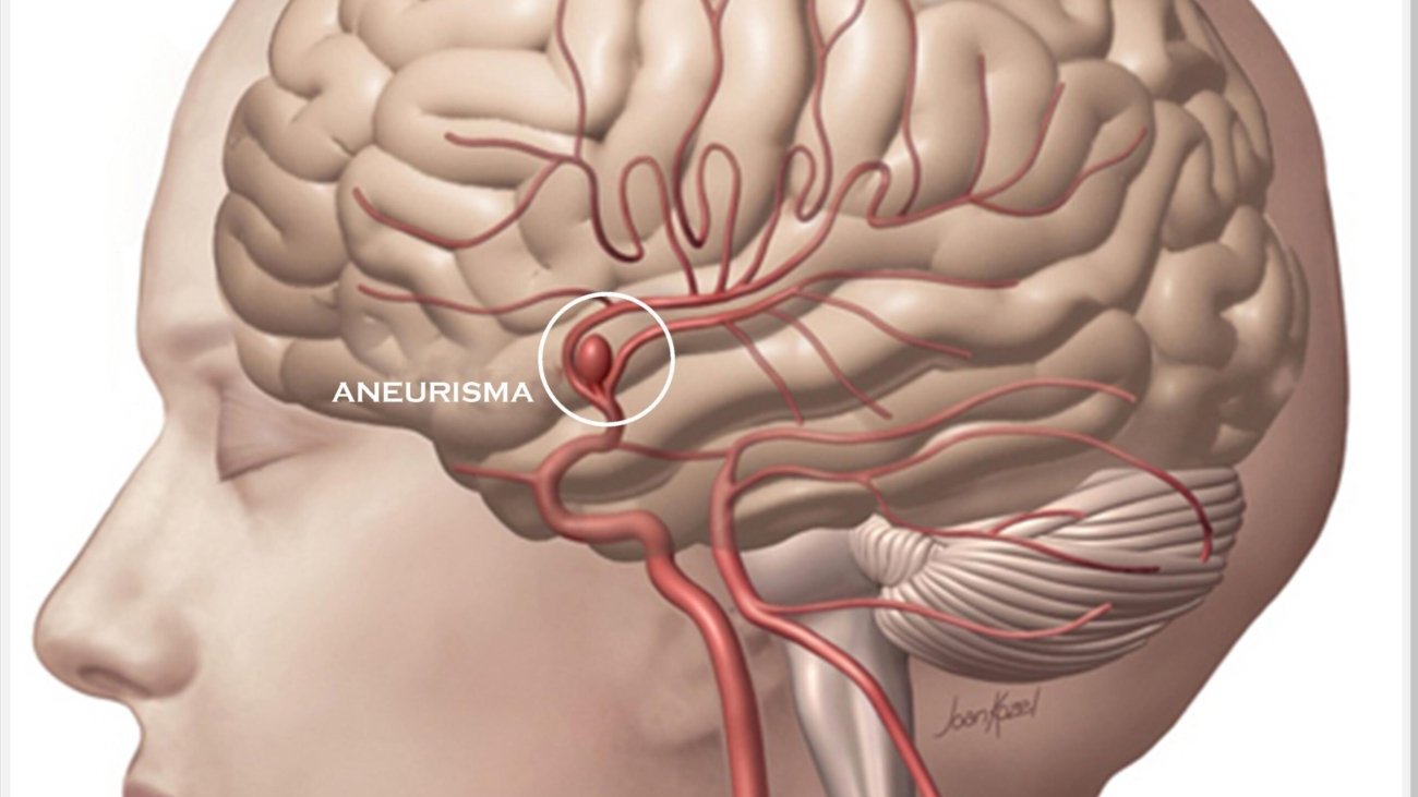 aneurisma-cerebral-dr-daniel-benitti-cirurgiao-vascular
