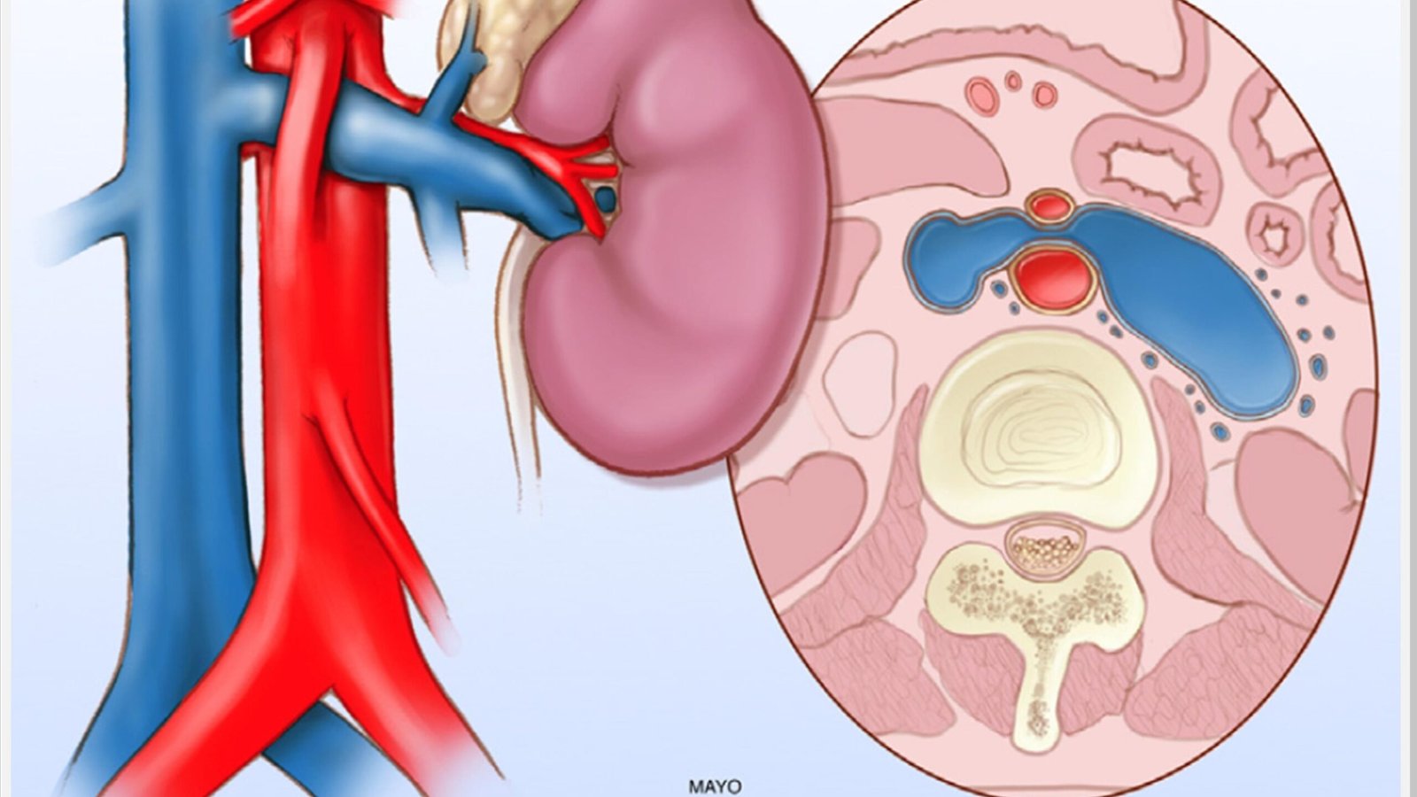 O que é Síndrome de Nutcracker? Cirurgião Vascular