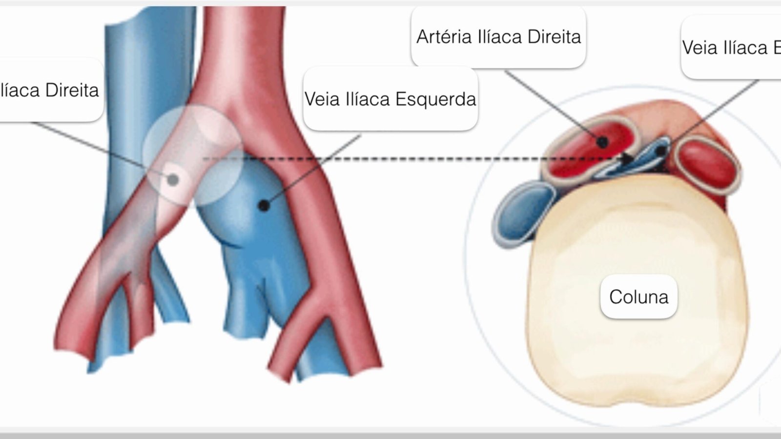 cockett-inchaco-perna-varizes-dr-daniel-benitti-cirurgiao-vascular-campinas