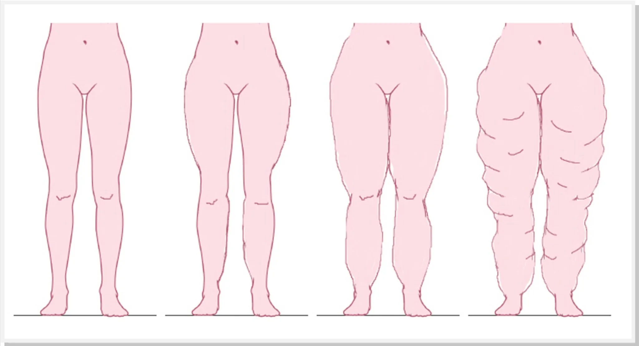 lipedema-dr-daniel-benitti-cirurgiao-vascular-campinas