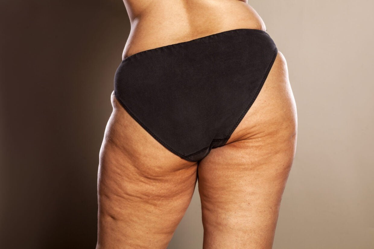 Excesso de gordura localizada pode ser sinal de problema vascular
