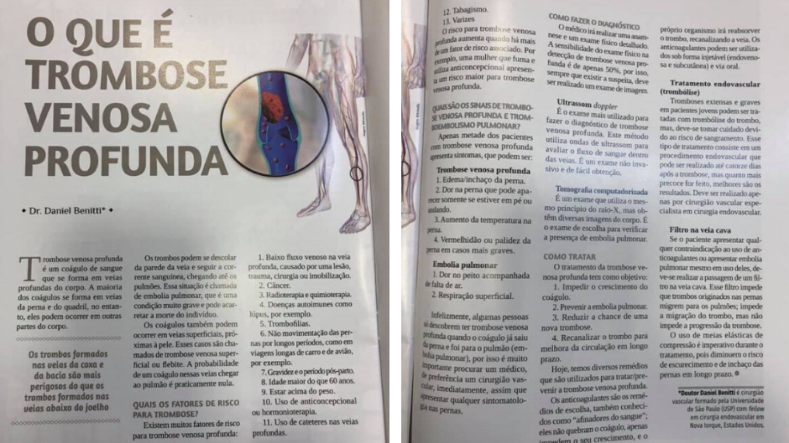 materia-trombose-revista-ana-maria-dr-daniel-benitti-cirurgiao-vascular-sao-paulo-campinas
