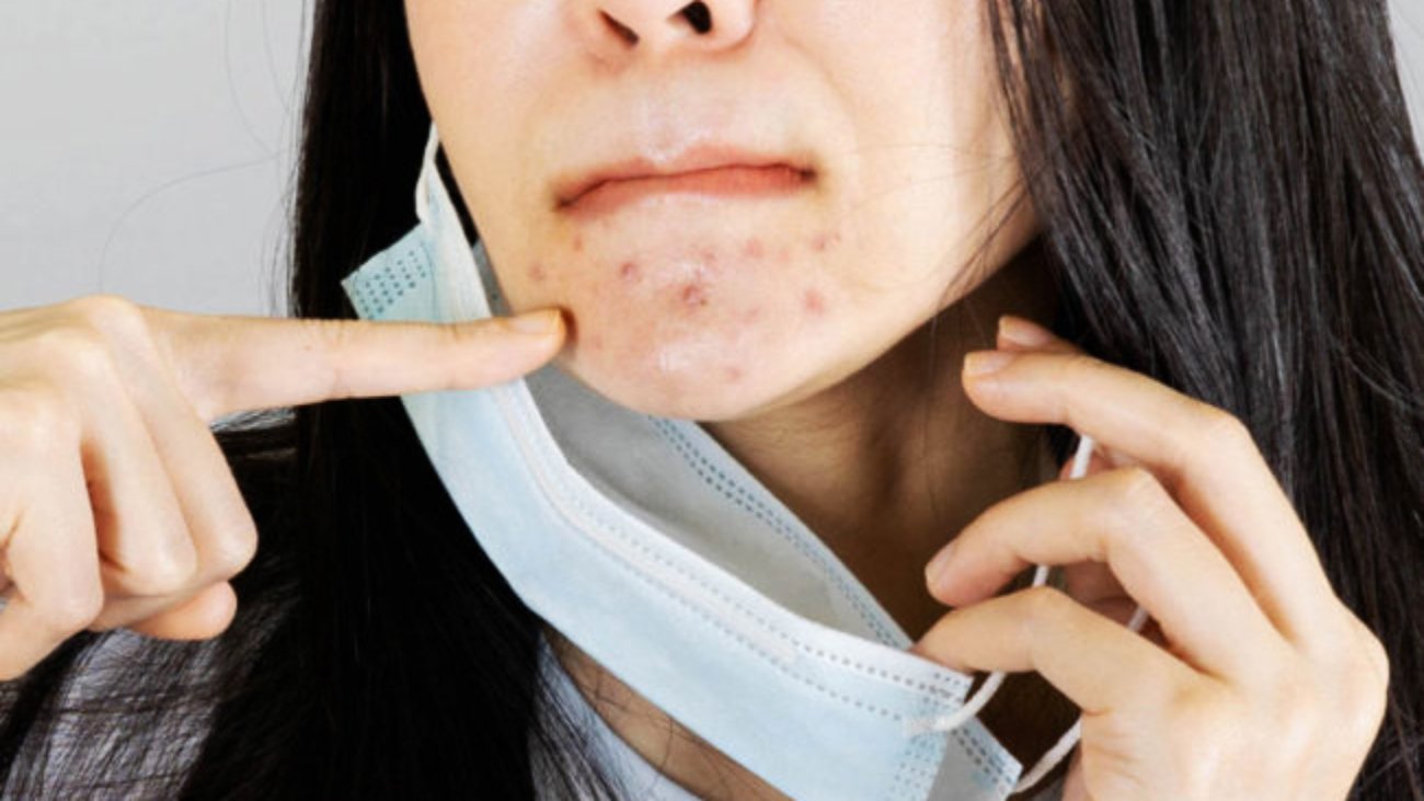 acne-espinhas-rosto-mascara-covid-19-dr-daniel-benitti-cirurgiao-vascular-sp-campinas