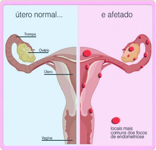 endometriose-dr-daniel-benitti-cirurgiao-vascular-sao-paulo-campinas
