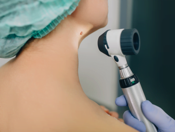 check-up-exame-cancer-pele-dr-daniel-benitti-cirurgiao-vascular-sao-paulo-campinas