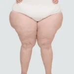 lipedema