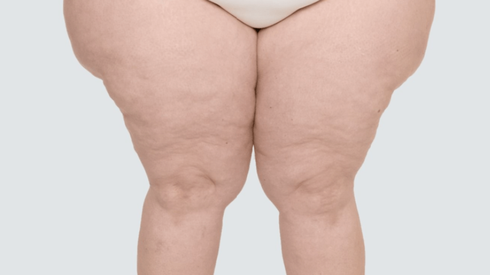 lipedema-dr-daniel-benitti-cirurgiao-vascular